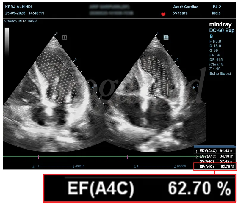 Hasil echocardiography setelah terapi, EF 62,70%