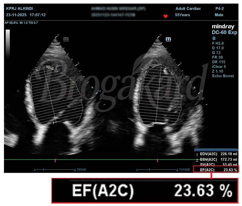 Hasil echocardiography sebelum terapi, EF 23,63%