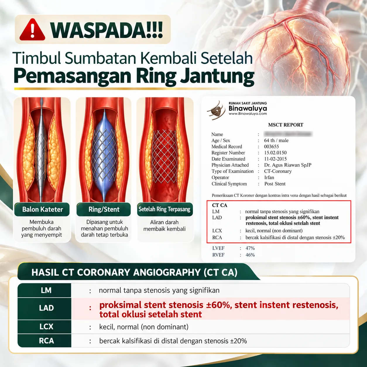Waspada: timbul sumbatan kembali setelah pemasangan ring jantung. Laporan MSCT pasien 64 tahun dengan stent in-stent restenosis pada LAD