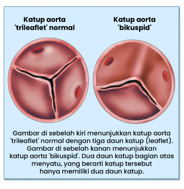 Bikuspid Aortic Valve