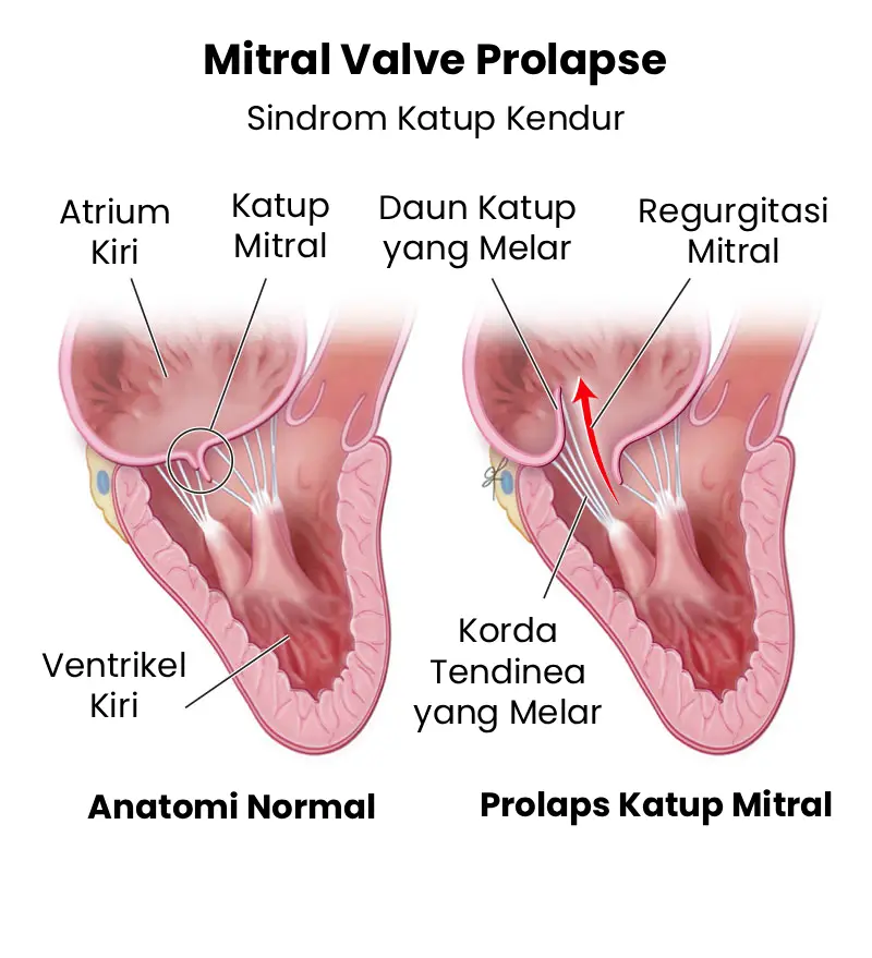 mitral valve prolapse