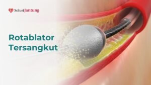 Rotablator Tersangkut Featured Image