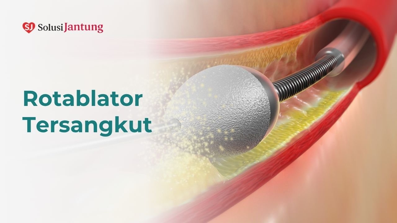 Rotablator Tersangkut Featured Image